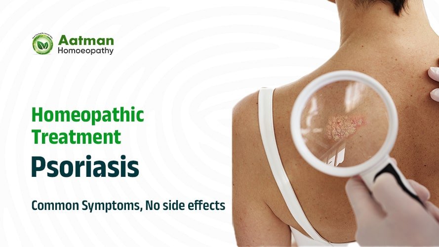 Home 11 Best homeopathic treatment for psoriasis